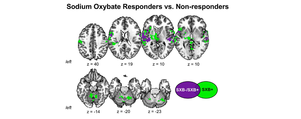 Diagram of the brain