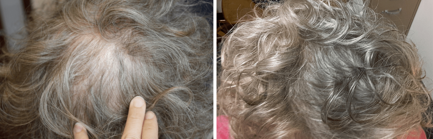 Hair transplant before and after photos